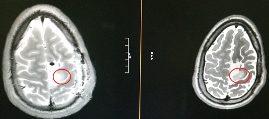 MRI Pre and Post Surgery Scans
