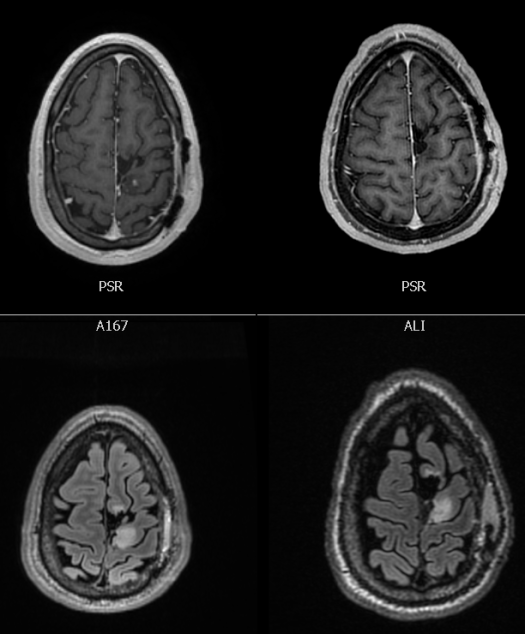 9-25-2018 MRI tumor images comparing 7-30-2018